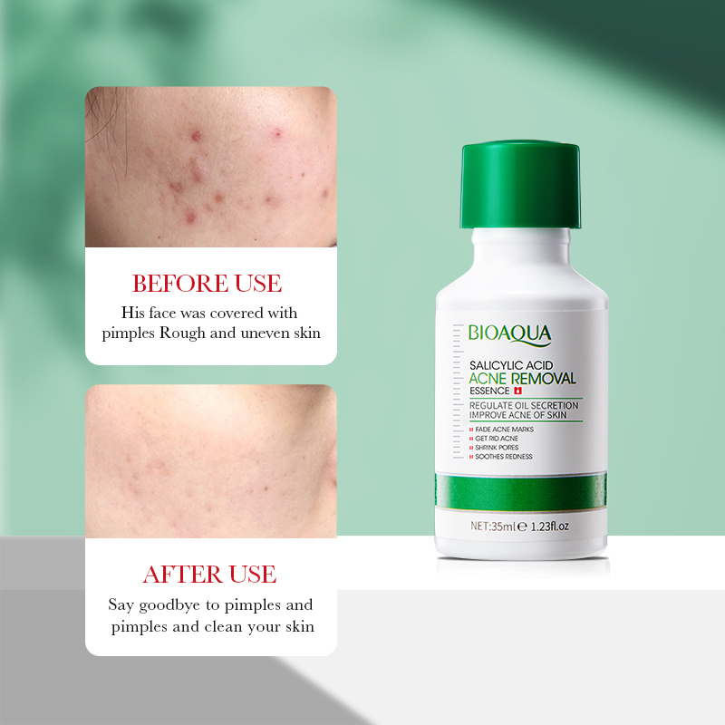 Esencia de eliminación antiacn - Tranexamic Acid Serum reseña y precio